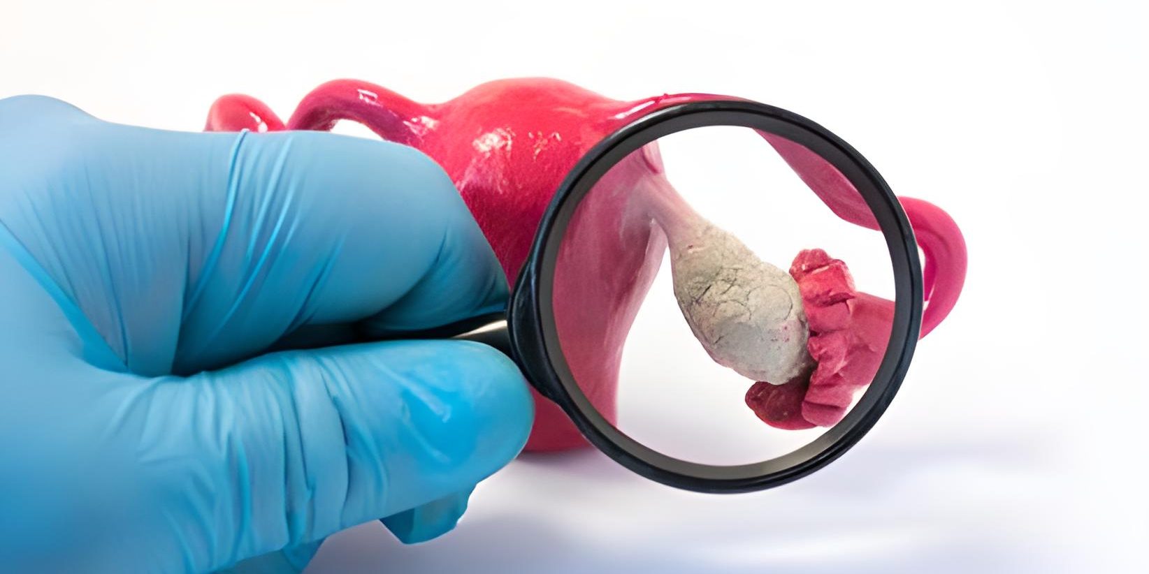 falsche-vorstellungen-über-das-polyzystische-ovarialsyndrom Falsche Vorstellungen über das PCOS