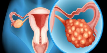 PCOS bei einer kinderwunscchbehandlung 