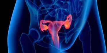 Was ist das Ovarielle Überstimulationssyndrom (OHSS)