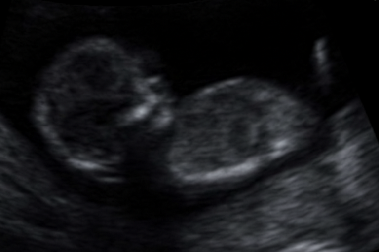 was-ist-hydrops-fetalis Was ist Hydrops Fetalis